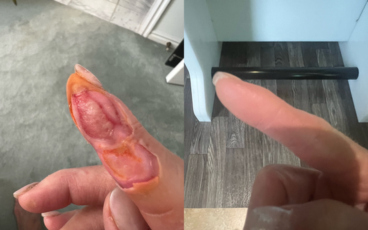Robin’s Remarkable Recovery: The Power of NOxyDERM